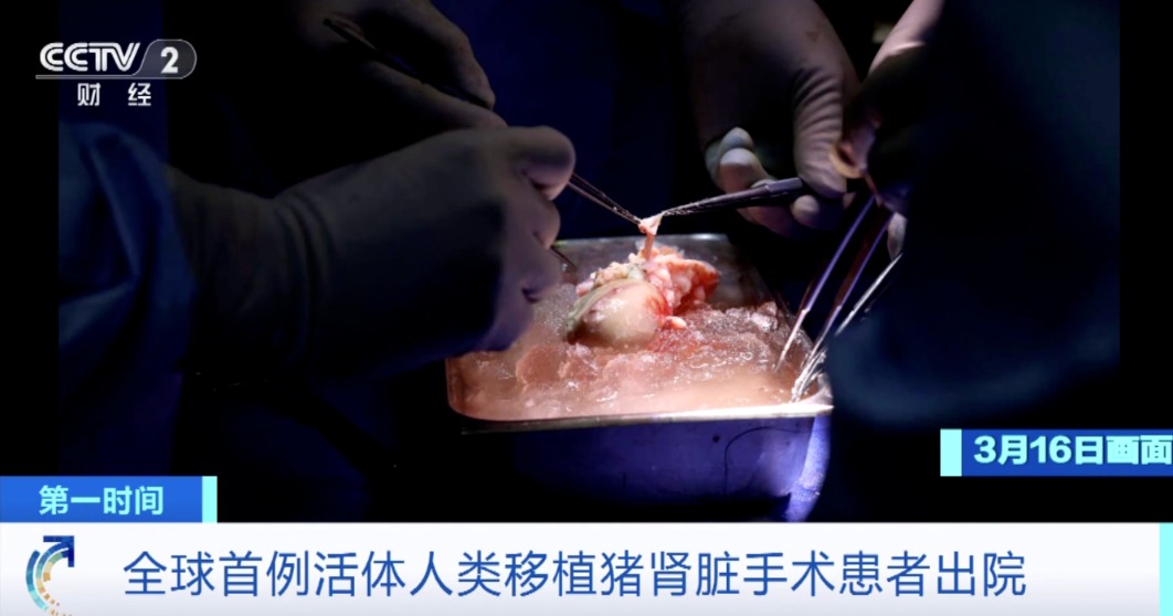 全球首例活体人类移植猪肾脏手术患者出院